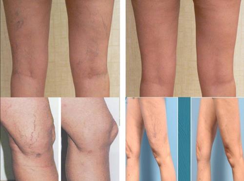 Varicele la picioare – ce sunt, de ce apar, tratament